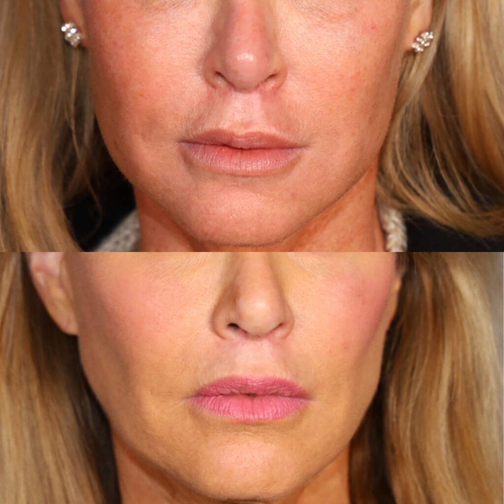 Face lift near me. Face lift Philly. Face surgery. Board certified plastic surgeon. Plastic surgery pa.