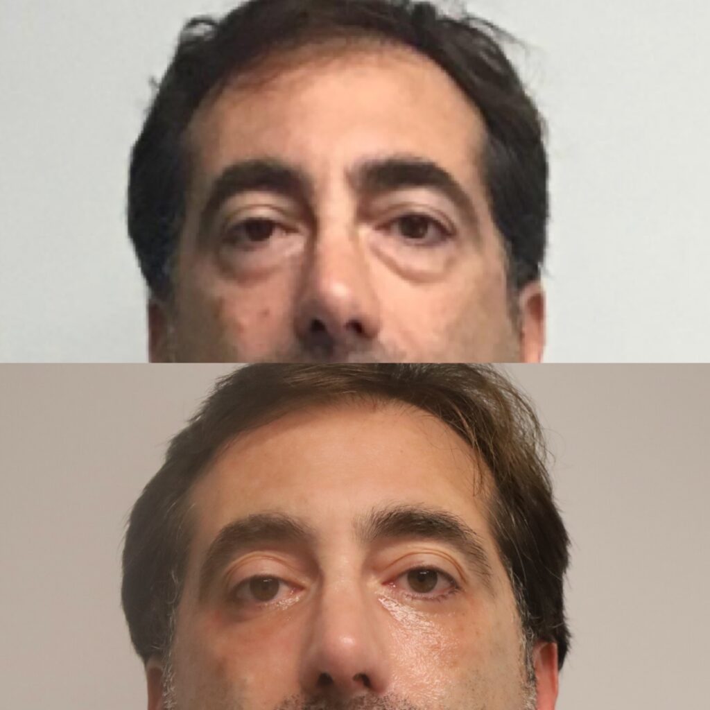 Eyelid Lift Results in Philadelphia, PA. Plastic Surgery Practice in Philly. Lower blepharoplasty. Eyelid surgery. Blepharoplasty surgeon.
