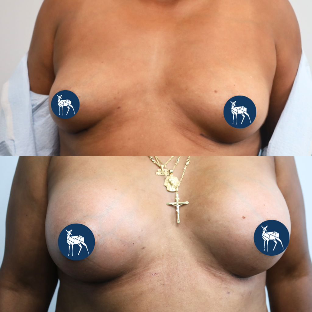 Breast Implant. Philadelphia cosmetic surgery. Breast augmentation in Philly.